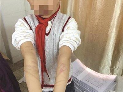 “强吻男孩引发水痘争议：律师称或涉故意伤害，法律边界何在？”